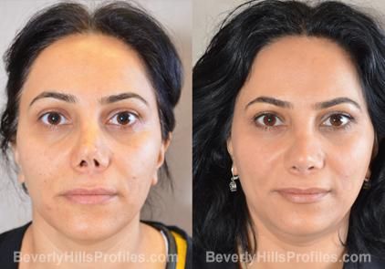 Image result for nostril  show reduction Nostril Reduction, Rhinoplasty Before And After, Before After Photo, Cosmetic Procedures, After Photos, Plastic Surgery, Beverly Hills, Surgery, Google Search