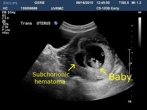 Subchorionic Hemorrhage: Definition, Diagnosis & Treatments - New Kids Center Subchorionic Hemorrhage, Baby Ultrasound Pictures, Ultrasound School, Obstetric Ultrasound, Ultrasound Sonography, Prenatal Appointment, Medical Ultrasound, Diagnostic Medical Sonography, Ultrasound Technician