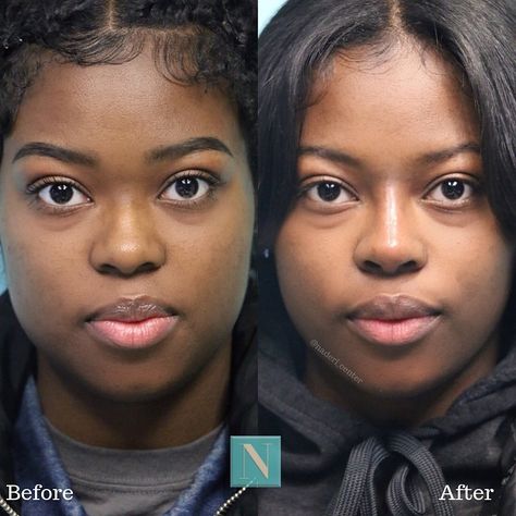 Rhinoplasty & Cosmetic Surgery on Instagram: “Nonsurgical Rhinoplasty by The Noseman on a young woman who came wanting a more defined and contoured bridge. The tip has also improved and…” Rhinoplasty Before And After Black Women, Small Nose Tip, Ethnic Rhinoplasty African Americans, Black Rhinoplasty, Lower Blephoraplasty Before And After, Rhinoplasty Before After, Ethnic Nose Job, Feminine Goals, Kpop Plastic Surgery