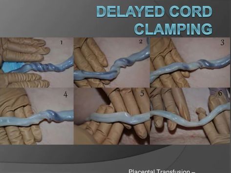 Placental transfusion : Delayed cord clamping Delayed Cord Clamping, What Is Stem, Cord Blood Banking, Umbilical Cord, Childbirth Education, Birth Doula, Birth Labor, Birth Plan, Home Birth