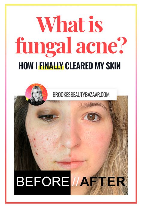 what is fungal acne? malassezia is actually a fungus that feeds on certain ingredients in your skincare and makeup products.. yikes! Unchecked, this fungus will spread over your face & body, causing a bumpy skin-tone rash (forehead bumps), or even worse - acne pustules! Luckily it's treatable without harsh chemicals or harmful medications. Find out how to get clear, glowing skin free from fungal acne on the blog.. #fungalacne #malassezia #acne #clearksin Acne On Forehead Reasons For, Fungle Acne, Bumpy Forehead, Treat Fungal Acne, Forehead Breakout, Bacterial Acne, Forehead Bumps, Face Breaking Out, Skincare And Makeup Products