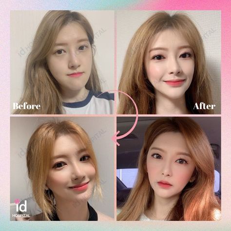 🌼 V-line Surgery to reduce the size of her jaw and chin 🌼 Double jaw surgery/ Orthognathic Surgery to fix her malocclusion (the surgery also reduces the mid-facial length) 🌼 Dual Canthoplasty 🌼 Incision Ptosis Correction #idhospitalkorea #plasticsurgery #plasticsurgerykorea #twojawsurgery #doublejawsurgery #doublejaw #vlinesurgery #vline #vlineface #orthognathic #facialcontouring #ptosiscorrection #doubleeyelidsurgery #epicanthoplaststy #lateralcanthoplasty #dualcanthoplasty Double Jaw Surgery, V Line Surgery, Plastic Surgery Korea, Orthognathic Surgery, V Line Face, Jaw Surgery, Facial Contouring, Double Eyelid, V Line