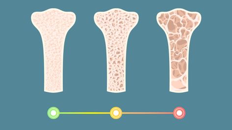 Stages of Osteoporosis: How to Stop Bone Loss in Its Tracks | Woman's World Bone Loss, Flamingo, Ups, Acting, Bones