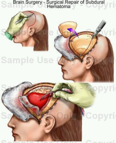 NeuroSurgery - brain surgery I had for brain aneurysm... Surgical Technician, Brain Surgeon, Medical School Inspiration, Medical School Studying, Brain Surgery, Medical Anatomy, Medical Studies, The Warning, Medical Tourism