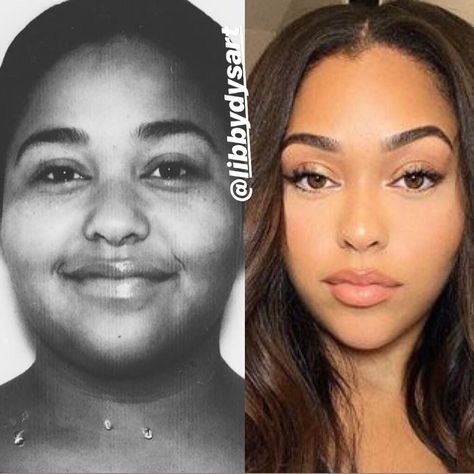 Jordyn Woods Rhinoplasty Recovery, Face Fat Loss, Jordyn Woods, The Glow Up, Fast Fat Loss, Dry Skin Patches, Nose Job, Lip Fillers, Yoga Training