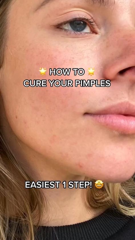 Teenage Facial Skin Care, How To Get Rid Of Blackheads On Nose, How To Get Rid Of Blackheads, How To Get Rid Of Pimples Overnight, Skin Care For Teenagers, Clear Skin Aethstetic, How To Get Clear Skin, Appearance Tips, Blind Pimple