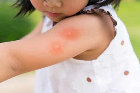 What's the difference between mosquito and bed bug bites?  https://www.bedbugsinsider.com/bed-bug-bites-vs-mosquito-bites/ Mosquito Bite Relief, Prevent Mosquito Bites, Bite Relief, Fever Symptoms, Calamine Lotion, Bed Bug Bites, Anti Itch Cream, Mosquito Control, Mosquito Bite