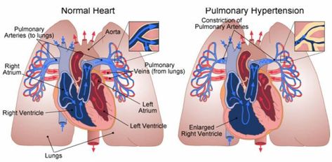 Fast Heartbeat, Hypertension Diet, Blood Pressure Food, Normal Heart, Blood Pressure Diet, Blood Pressure Cuff, Lung Disease, Healthy Blood Pressure, Chest Pain