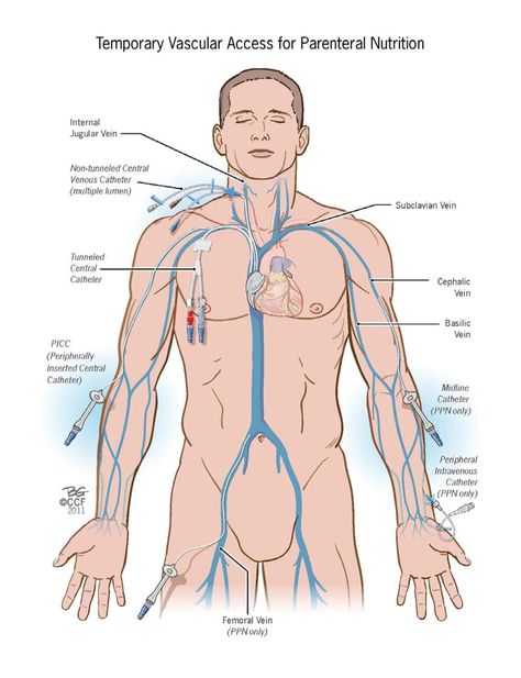 Venous Access for PN // ACG Nursing Iv, Parenteral Nutrition, Nursing Cheat, Nursing Board, Nursing Mnemonics, Nursing School Survival, Nurse Rock, Nursing School Studying, Iv Therapy