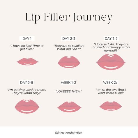 ATLANTA BOTOX & FILLER on Instagram: “Swelling is to be expected! I always recommend doing lip filler at least 2 weeks before a big event 😘 #atlinjector #atllipfillers…” Botox Filler, No Lips, Lip Filler, Botox Fillers, Lip Fillers, Atlanta, Lips, On Instagram, Instagram