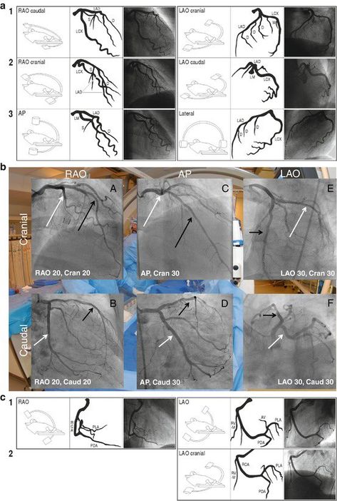 Coronary Angiography Views, Cardiac Cath Lab Nurse, Cath Lab Nursing, Cardiac Cath, Cath Lab Nurse, Cardiac Anatomy, Cardiac Sonography, Medical School Interview, Cardiology Nursing