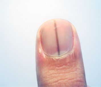 A doctor explains the differences between a melanoma black line under the fingernail and a normal one. “Splinters or dark streaks under nails can occur when microscopic areas of bleeding happen and allow blood to … Line Down Middle Of Nail, Line On Nails, Vertical Ridges On Fingernails, Nail Health Signs, Nail Symptoms, Fingernail Health, Nail Disorders, Toenail Health, Nail Signs