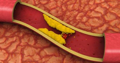 Rising Landscape of the Cholesterin Industry in Europe Market Outlook: Ken Research Regime Anti Cholesterol, Cholesterol Symptoms, Cholesterol Medications, Clogged Arteries, Cholesterol Remedies, Cholesterol Lowering Foods, Hdl Cholesterol, Cholesterol Diet, Low Cholesterol