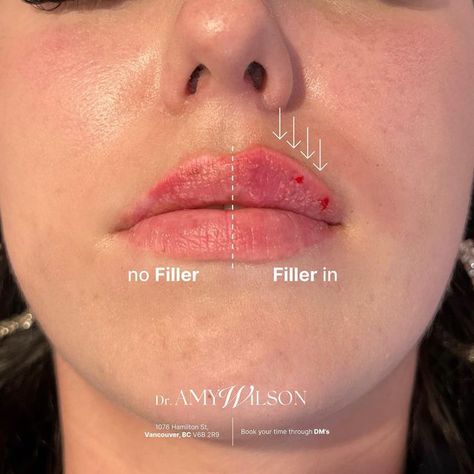 Lip Fillers Cupids Bow, Full Lips Injections, Lip Filler Bottom Lip Bigger, Lip Filler With Cupids Bow, Heavy Lower Lip Filler, Heart Shape Lips Fillers, Bigger Upper Lip, Upper Lip Filler, Bow Shaped Lips