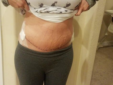 Diastasis Recti Repair Surgery Pt: 3 – The Crazy Outdoor Mama Diastasis Recti Surgery, Diastasis Recti Surgery Before And After, Diastasis Recti Before After, Mommy Makeover Surgery Recovery, Diastasis Recti Repair, Tummy Tucks Recovery, Mommy Makeover Surgery, Mommy Pooch, Wellness Space