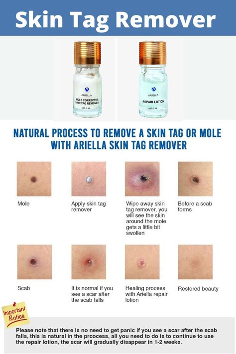 Remove Skin Tags, Remove Skin Tags Naturally, Tag Remover, Mole Removal, Losing 40 Pounds, Skin Tags, Home Remedy For Cough, Cold Sores Remedies, Natural Sleep Remedies