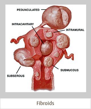 Good Eyesight, Fibroid Diet, Fibroid Uterus, Fibroid Surgery, Fibroid Tumors, Healthy Cholesterol Levels, Wellness Company, Ph Levels, Reproductive System