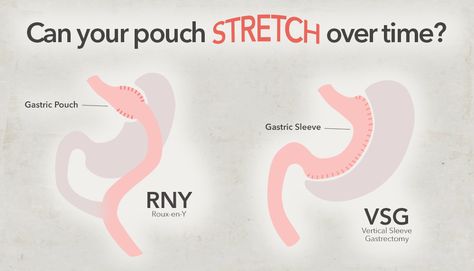 Stomach Stretches, Vertical Sleeve Gastrectomy, Bariatric Sleeve, Gastric Problem, Pediatric Surgery, Bariatric Friendly Recipes, Bariatric Surgeon, Bariatric Diet, Sleeve Gastrectomy