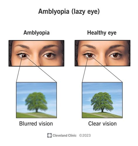 Lazy Eye Exercises, Making Characters, Blurry Eyes, Eye Function, Droopy Eyelids, Lazy Eye, Types Of Surgery, Eye D, Blurry Pictures