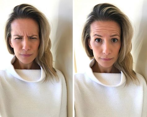 Botox: Advice, Regrets And Before + After - my kind of sweet Dysport Before And After Forehead, Botox 11 Lines Before After, Botox For Hooded Eyelids, Botox Before After, Beauty Injections, Botox Forehead, Botox Results, Cosmetic Fillers, Botox Before And After