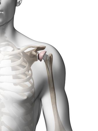 Zimmer Biomet Shoulder Replacement Class Action for Comprehensive Reverse Should Recall Shoulder Replacement Exercises, Paragard Iud, Reverse Shoulder Replacement, Hip Implants, Combat Arms, Personal Injury Claims, Class Action Lawsuits, Bone Loss, Personal Injury