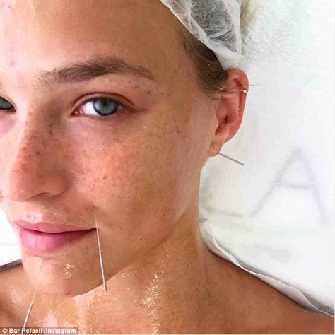 Treating herself: Bar Refaeli took time out to relax with some acupuncture on Monday and posted the picture of herself with needles sticking out of her face to Instagram Cosmetic Acupuncture, Natural Botox, Acupuncture Benefits, Botox Alternative, Natural Beauty Treatments, Wrinkle Free Skin, Bar Refaeli, Facial Rejuvenation, Acupuncture Points