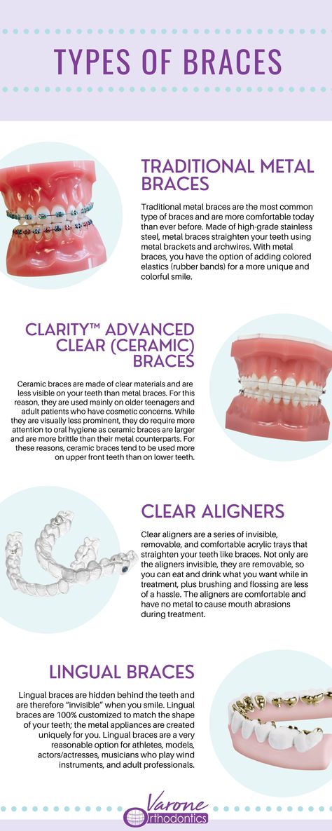 Orthodontist, Straight Teeth, Braces, Invisalign, Clear Aligners, Clear Braces, Types of Braces Braces Types, Teeth After Braces, After Braces, Ceramic Braces, Types Of Braces, Clear Braces, Clear Aligners, Straight Teeth, Metal Braces