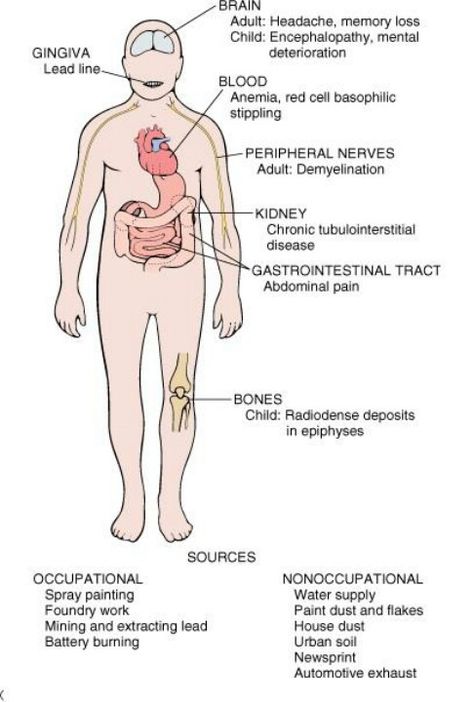 Lead poisoning- symptoms and sources. Think you might be poisoned? Come get tested at our office in Manchester, NH for free! (603) 781-4304 Lead Poison Symptoms, Chelation Therapy, Poisoning Symptoms, Nerdy Nurse, Nclex Review, Peripheral Nerve, Flint Michigan, Manchester Nh, Medical Studies