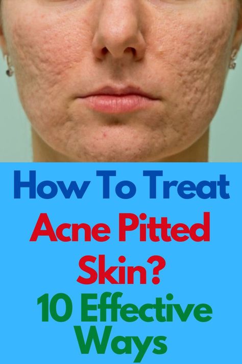 How To Treat Acne Pitted Skin? 10 Effective Ways What Helps With Acne Scarring, Pitted Acne Scar Removal, How To Fix Acne Scarring, Acne Pit Scars, Acne Holes, Cystic Acne Remedies, Acne Scaring, Acne Overnight, Acne Scarring