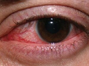 Keratitis Dry Eye Symptoms, Bloodshot Eyes, Swollen Eyes, Parts Of The Eye, Irritated Eye, Eye Infections, Sore Eyes, Healthy Eyes, Eyes Problems