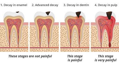 Eating Raw Garlic, Tooth Cavity, Diy Medicine, Tooth Decay Remedies, Heal Cavities, Too Much Sugar, Eating Too Much, Dental Cavities, The Teeth