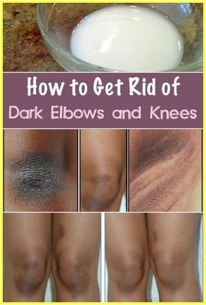 Dark Elbows And Knees, Dark Elbows, Skin Care Routine For 20s, Black Skin Care, Beauty Remedies, Skin Remedies, Skin Care Remedies, Whitening Cream, Beauty Skin Care Routine