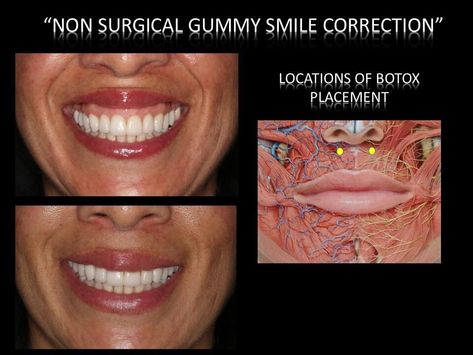 Laurence Rifkin on Twitter: "Correct gummy smile. No surgery. I use Botox and derm filler's. #gummysmile #BeverlyHillsDentist #CelebrityDentist #perfectsmile #Suite1200 https://t.co/vuMqqsBLYO" / Twitter Gummy Smile Correction, Hyaluronic Pen, Aesthetic Nursing, Botox Injection Sites, Botox Cost, Botox Clinic, Botox Injection, Botox Before And After, Botox Face