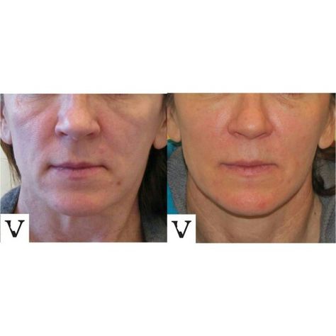 Non-surgical facelift with Sculptra, lasts about 2 years www.visagesculpture.com #boston #facelift #face #radiesse #juvederm #botox #sculptra #rhinoplasty #nosejob #alternative #injection #expert #newton #asymmetry #correction #reconstruction #hiv #lips #eyes #beauty #taste #youth #young #proportion #selfesteem #juvederm #belotero #merz #galderma #allergan #botox #sculptra #rhinoplasty #nosejob #lips #eyes #chin #augmentation #jaw #reduction #face #slimming #visagesculpture #mashabanar #restylane #radiesse #botox Allergan Botox, Chin Augmentation, Non Surgical Facelift, Nose Job, Face Shapes, Body Care, Boston, Facial, Lips