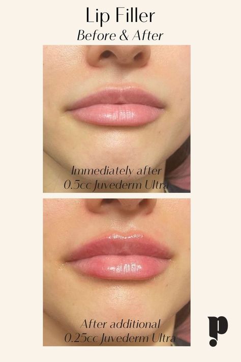 Before and After of lip injections/filler with .75 cc of Juvederm Ultra. 1st photo is after .5 cc & 2nd is with .25 cc more. Symmetry of the upper lip was created as well as a subtle definition of the cup's bow (2 peaks of the upper lip), defined Vermillion Boarder, and volume added without inflating. Lip Border Definition Filler, Upper Lip Filler, 1 Ml Lip Filler Before And After, Cupids Bow Lips, Botox And Fillers, Facial Contouring, Cosmetic Injectables, Lip Augmentation, Lip Filler