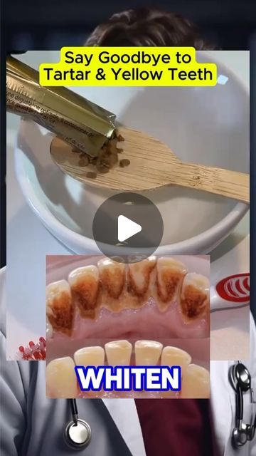 Tip Remedies on Instagram: "Natural #recipe to whiten your teeth and remove tartar at home.

Follow us on new page @tip2remedies for updates!
#recipes #recipe #naturalremedy #naturalremedies #remedy #us #usa" Teeth Tartar, Natural Teeth Whitening Diy, Natural Teeth Whitening Remedies, Tartar Teeth, Baklava Recipe, Teeth Whitener, Teeth Whitening Remedies, Teeth Whitening Diy, Whiten Your Teeth