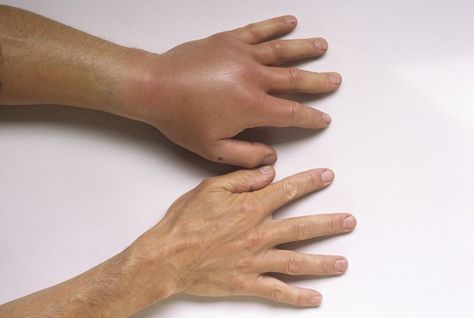 Close-up of two hands, one badly swollen. Swollen Hands, Backyard Ponds, Get Rid Of Warts, Chest Pain, Invisible Illness, Chronic Fatigue, Autoimmune Disease, Ponds, Chronic Illness