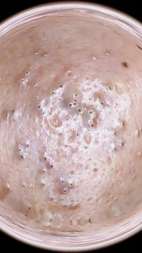 pimples popping video  #ance #squeeze #squeezepip #satisfying #acne #fyp #beauty #pimpleacne #foryou Satisfying Pimple Pops, Pimple Poppìng Videos Satisfying, Pimple Poppìng Videos, Pimple Poppìng, Big Zits, Closed Comedones, Pimple Popper Videos, Pimple Pop, Popping Pimples