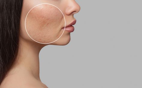 Facial Scars, Skin Diet, Treating Hyperpigmentation, Brown Spots On Face, Professional Skin Care Products, Skin Care Routine Steps, How To Treat Acne, Skin Rejuvenation, Skin Problems