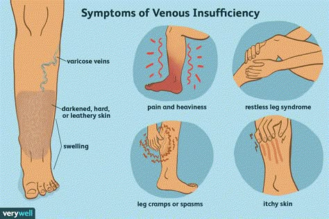 Medical Laboratory Science Student, Nyu Langone, Peripheral Artery, Vascular Ultrasound, Leg Circulation, Leg Ulcers, Varicose Vein Remedy, Leg Veins, Vein Removal