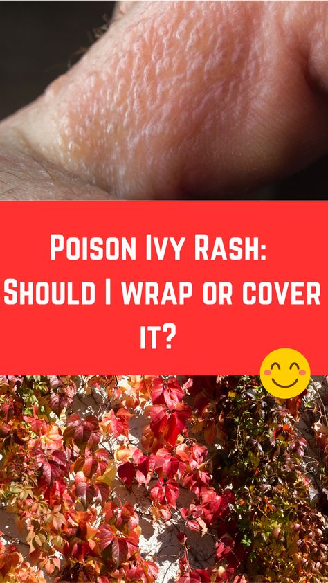 Poison Ivy Rash: Should I wrap or cover it? (What to do) How To Treat Poison Ivy, Home Remedy For Poison Ivy Rash, Get Rid Of Poison Ivy Rash Fast, How To Get Rid Of Poison Ivy Rash, How To Dry Up Poison Ivy Rash, How To Treat Poison Ivy Remedies, Poison Oak Rash Pictures, Poison Ivy On Skin, Poison Ivy Rash Pictures