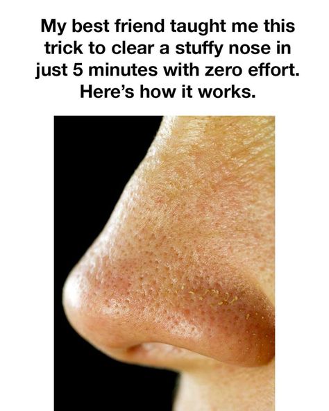 Oh, that's cool! I didn't know that before. What To Do For Stuffy Nose, Clogged Sinuses Remedies, Nasal Pressure Relief, Home Remedy For Nasal Congestion, How To Help A Stuffy Nose, How To Get Rid Of A Sinus Infection, How To Decongest Your Nose, How To Stop A Stuffy Nose, Head Cold Remedies Nasal Congestion