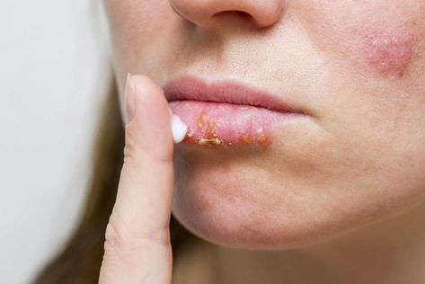 Lip Blister Remedy, Sun Blisters, Sunburn On Face, Global Boiling, Sunburnt Lips, Sunburn Blisters, Blister Remedies, Blister On Lip, Sunburned Lips