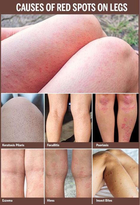 Red Spots on Legs | Femina.in Red Spots On Legs, Red Spots On Face, Bumps On Legs, Leg Rash, Red Skin Spots, Redness Pimple, Red Rash, Spots On Legs, Keratosis Pilaris