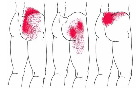 Gluteus Medius Muscle | Anatomy, Function, Pain, & Relief Hip Muscles Anatomy, Gluteus Medius Exercises, Hip Anatomy, Muscles Anatomy, Running Muscles, Glute Medius, Referred Pain, Muscle Knots, Hip Problems