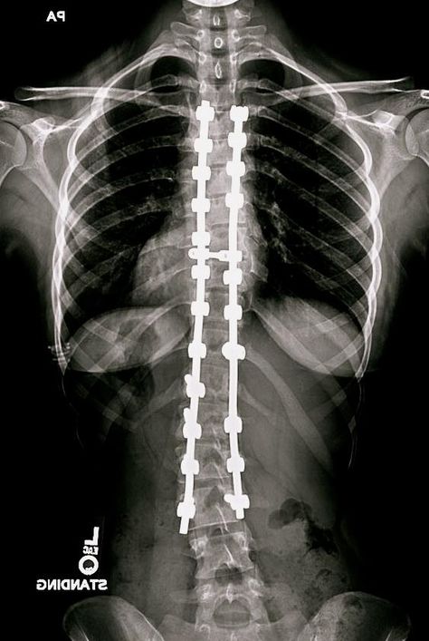 Spinal Fusion Surgery. Mine looks just like this Open Skull, Exercises For Lower Back, Spinal Fusion Surgery, Failure To Thrive, Spinal Fusion, Spinal Surgery, Spinal Injury, I Can Only Imagine, Back Pain Remedies