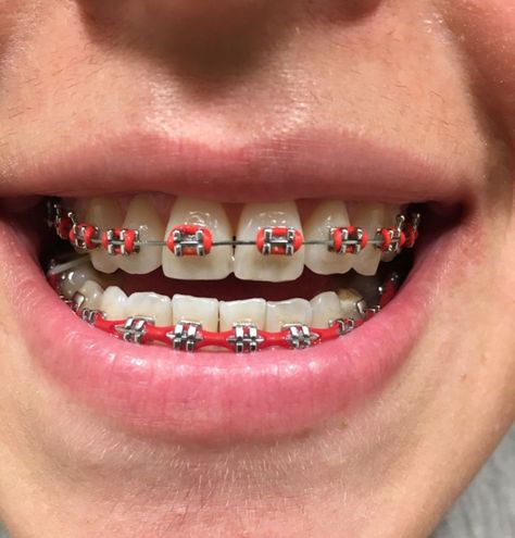 #braces #red #braces Red Braces Teeth, Braces Colors Black, Braces Colours, Braces Colors Combinations, Invisible Teeth Braces, Red Braces, Braces Colors Ideas, Lingual Braces, Natural Teeth Whitening Diy