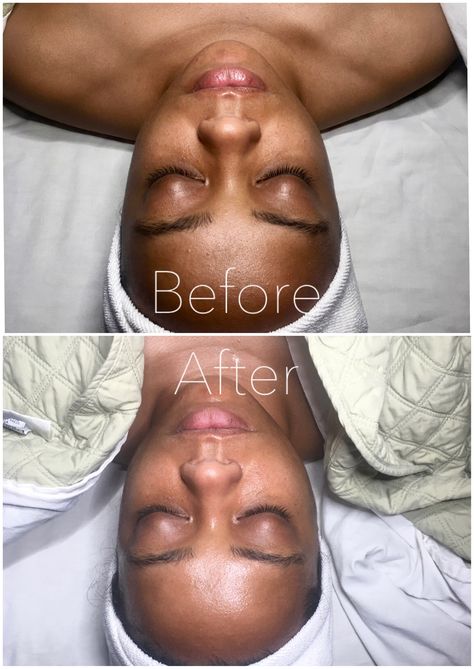 Before And After Facial Pictures, Facials Before And After, Facial Before And After, Esthetician School, Self Care Habits, Diy Anti Aging, Astral Projection, Anti Aging Facial, Practice Yoga