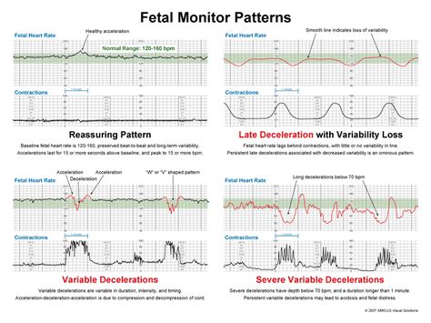 Fetal Monitoring VEAL CHOP Variable decelerations…..Cord compression Early decelerations………Head compression Accelerations…………….OK, may need Oxygen Late decelerations……….Placental Insufficiency Maternal Nursing, Fetal Monitoring, Fetal Heart Rate, Nurse Teaching, Newborn Nursing, Veal Chop, Ob Nurse, Child Nursing, Labor Delivery Nursing