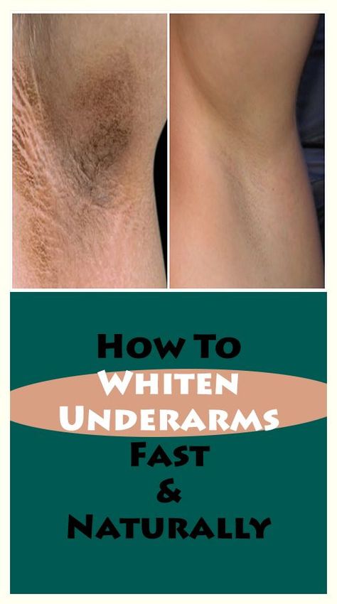 This is a Tiptop information! Whiten Underarms Fast, Rid Of Dark Underarms, Whiten Underarms, How To Whiten Underarms, Dark Armpits, Underarm Whitening, Dark Underarms, Natural Cleanser, Word Online